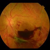 Figura 2. Retinopatia Diabética Proliferativa