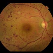 Figura 1. Retinopatia Diabética Não Proliferativa